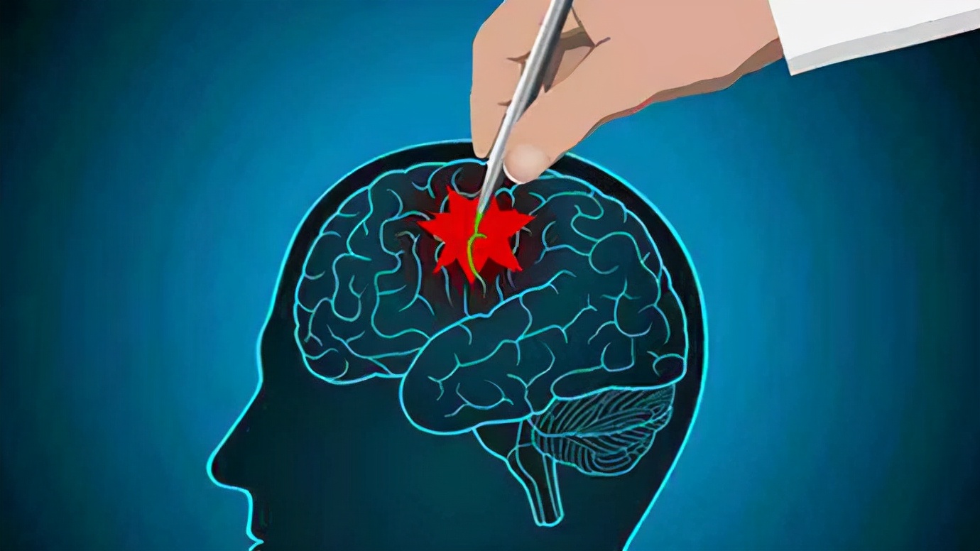 癫痫耐药怎么办？科学破局的全维度应对策略